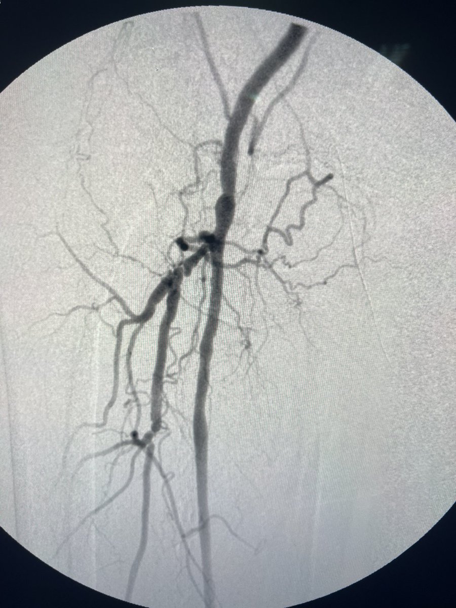 ChaconMatoso's tweet photo. 72 y/o,female, hypertensive, diabetic, with coronary disease, with femoro-popliteal bypass with great saphenous vein 2 years ago, evolving with Doppler surveillance changes and ABI drop.  performed angioplasty with drug balloon  (Stellarex). #endovascular #bypass https://t.co/pc8iTbsTFH