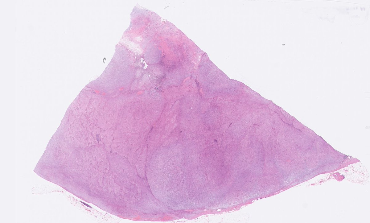 50ish y/o male with large, non-producing adrenal lesion. Lights up on FDG-PET. Suspicious for adrenal cortical carcinoma. Surgery is recommended. (Mini-thread)