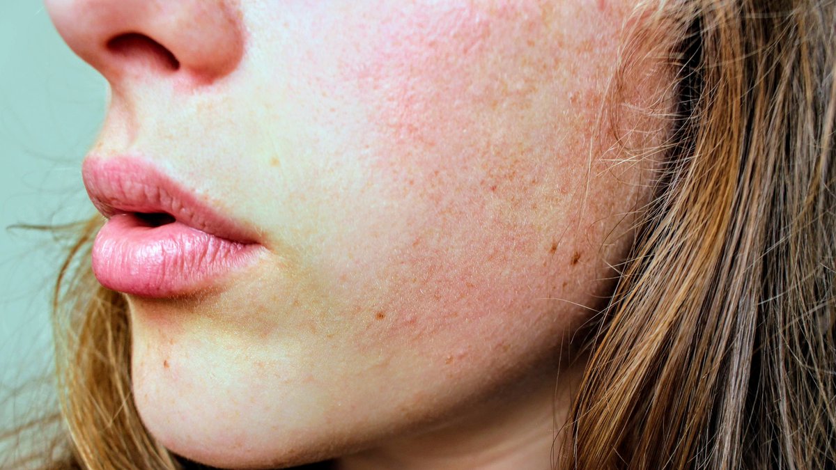 MTMtweet's tweet photo. Birth control pills are a common trigger for melasma. Birth control pills contain the hormone estrogen. Estrogen stimulates the production of melanin, which is the pigment that gives skin its color. https://t.co/nOL3xUAIwy https://t.co/iFNFG0JU0b