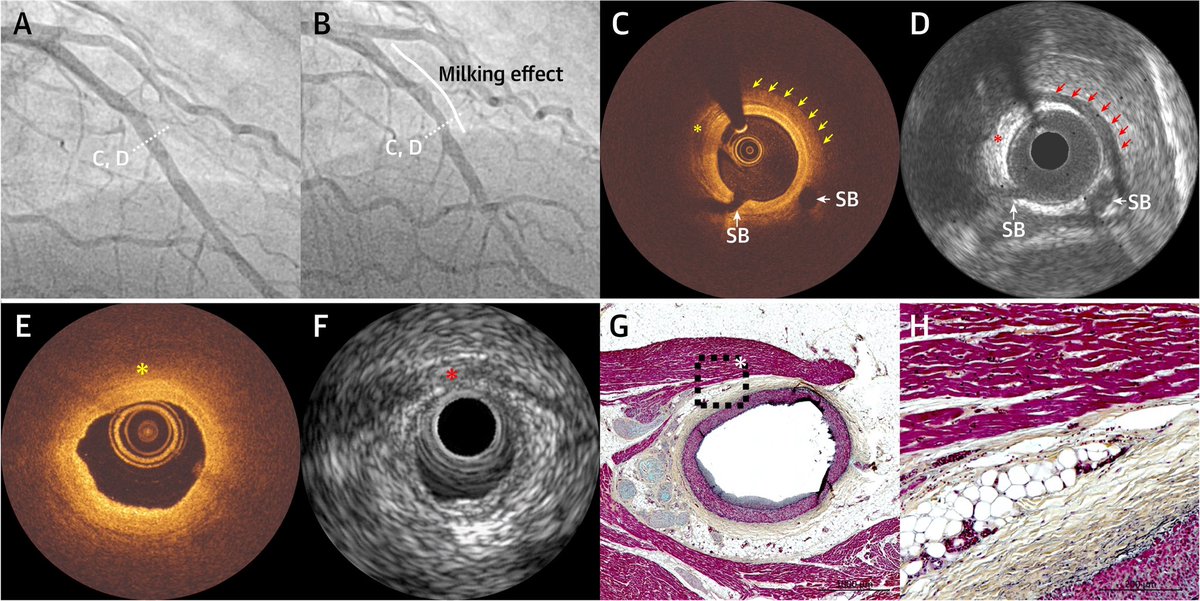 RaberLorenz's tweet photo. How does a myocardial bridge 🌉 look by #OCT❓In a collaborative analysis with Dr Renu Virmani, Washington, USA we present the results of a histological🔬validation and a clinical IVUS-OCT matching study reported in JACC Imaging.#CardioTwitter https://t.co/31pHnIR5FV https://t.co/xc62AqQaHZ
