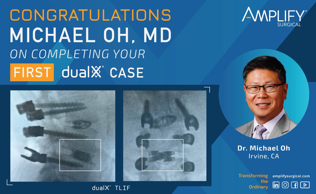Congratulations to Vice Chair of <a href="/UCINeurosurgery/">UC Irvine Neurosurgery</a>  Dr. Michael Oh <a href="/MYOSpineMD/">Michael Oh MD</a> who performed his first dualX TLIF today. The expandable cage minimizes subsidence while maximizing footprint. At UCI Spine our mission is to take the restorative benefits of MISS to new heights!