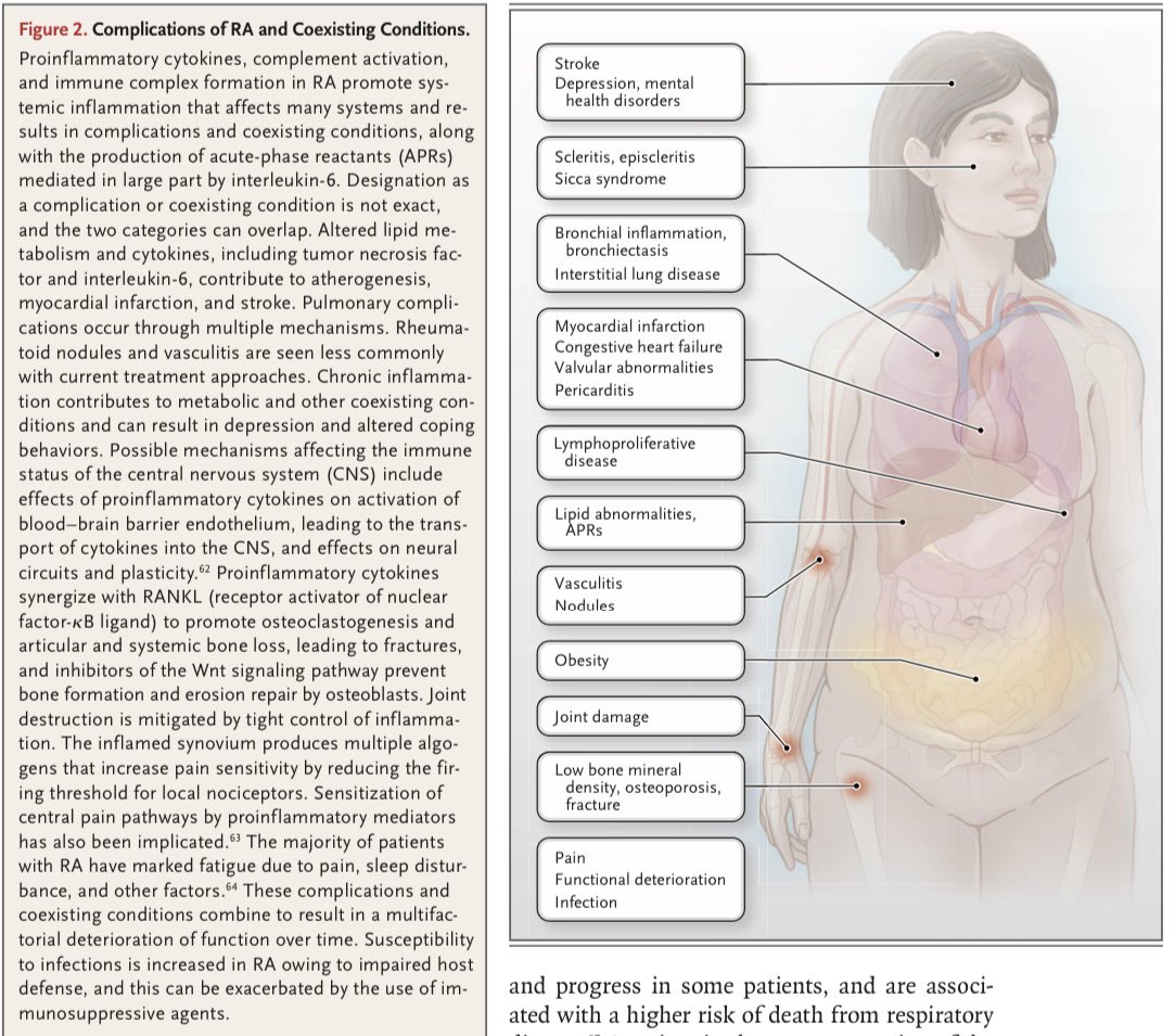 Great review article in <a href="/NEJM/">NEJM</a> on #rheumatoid arthritis. Our understanding of the disease and options for management have come such a long way!