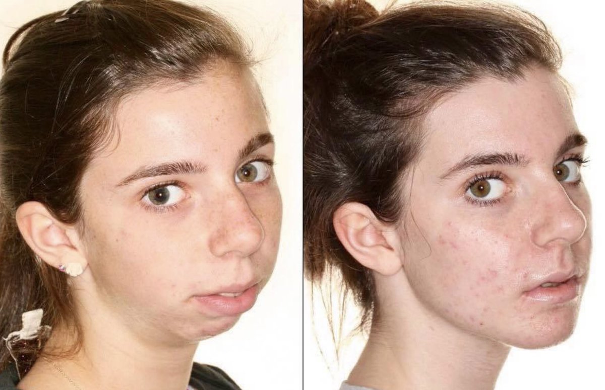 HowardFarran's tweet image. What orthognathic surgery can do.