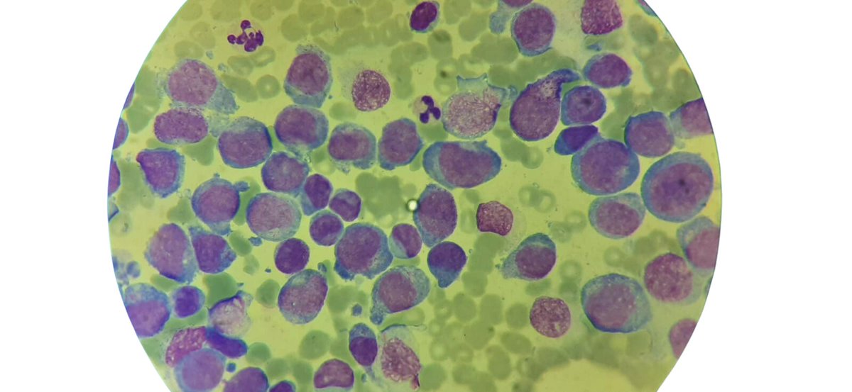 CEA_HIBA's tweet photo. 🧑de 47 a que consulta a la guardia por astenia, hematomas espontáneos en piel de 14 d, agrega🤒+ odinofagia.
En el frotis de🩸se observa lo siguiente ⬇️
¿Cuál es el diagnóstico más probable?  Comenten! Gracias sección de hematología por las imágenes! @SchutzNatalia #MedTwitter https://t.co/X70g938hoq