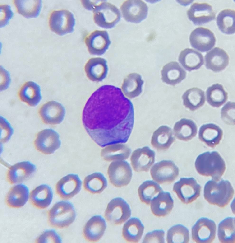CEA_HIBA's tweet photo. 🧑de 47 a que consulta a la guardia por astenia, hematomas espontáneos en piel de 14 d, agrega🤒+ odinofagia.
En el frotis de🩸se observa lo siguiente ⬇️
¿Cuál es el diagnóstico más probable?  Comenten! Gracias sección de hematología por las imágenes! @SchutzNatalia #MedTwitter https://t.co/X70g938hoq