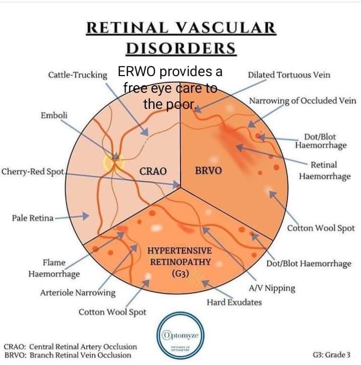 All these retinal vascular diseases can significantly affect the eyesight.
 #ophthotwitter #MedTwitter
#Retina #choroid #vitreous #DiabeticRetinopathy #AntiVEGF
@v_ophthalmology   #VOPHA #eyes #Ophthalmology  #AAO #Optometry  #eyehealth #eyeacuity