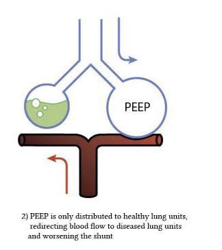 drshahrul80's tweet photo. “🚨Excessive PEEP can reduce perfusion to lung areas with high compliance and increase perfusion of pathological areas, increasing the shunt.

🚨It can also worsen hypoxemia in some cases due to reduced cardiac output.

Individualized PEEP is the way to go!”By @curso_vm #FOAMcc https://t.co/l7ghQtQYqC