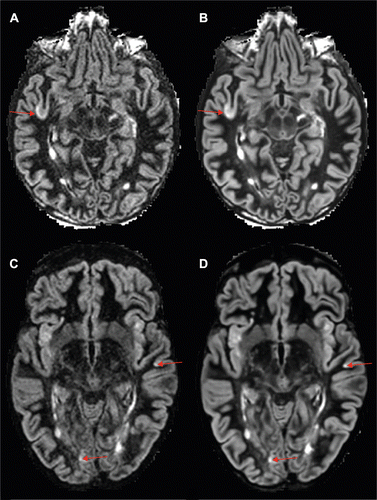 NeuroLaura's tweet photo. New publication online! 😀"Multicenter Evaluation of AI-generated DIR and PSIR for Cortical and Juxtacortical Multiple Sclerosis Lesion Detection". 

https://t.co/mj6Njpmxa5 https://t.co/Kp4p5ZxdqM