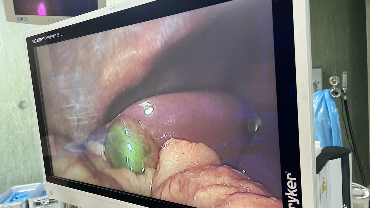 MuftahBoughrara's tweet photo. Gangrenous GB 🥺 #laparoscopic_cholecystectomy https://t.co/t8ZXPaMMgA
