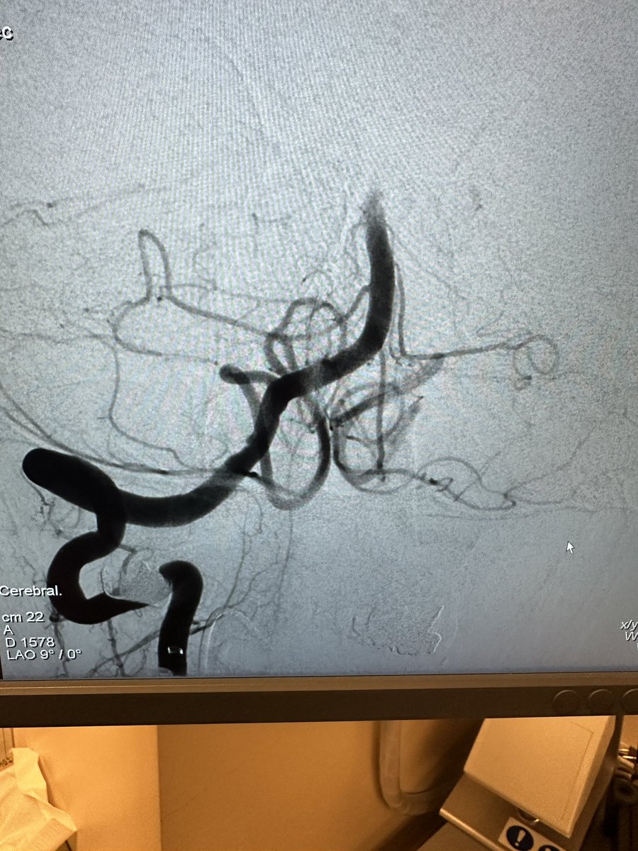 ZRBNeurosurgery's tweet photo. 74M basilar tip occlusion with left sided plegia, bilateral ptosis, dizziness. Right distal radial approach #ZoomRDL, #Zoom71, #Zoom35, and Aristotle 018. One pass aspiration TICI3. Great job @imperative_care! https://t.co/yjOvb1NCmw