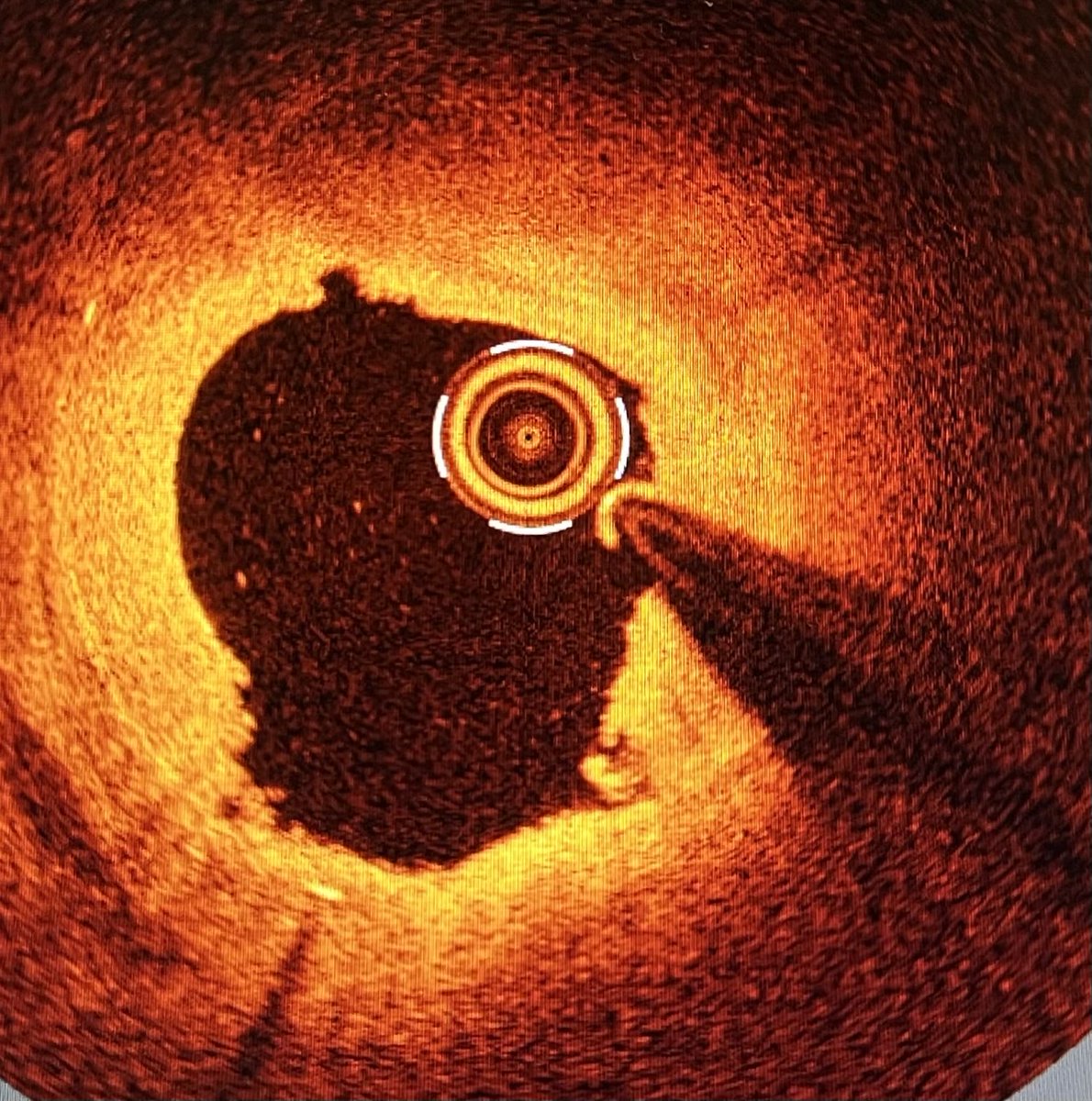 afcisnal's tweet photo. Cutting lines at 11 and 5 in a in-stent restenosis treated with cutting balloon. #OCTisBack ⁦@gema_minana⁩ ⁦@HemodinamicaVLC⁩ https://t.co/vglfK6URmu