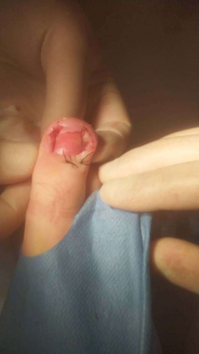 CCalasparra's tweet photo. Nueva Edición de nuestros Jueves Quirúrgicos.  Hoy entre otras cosas una uña encarnada recidivante.  Laminectomia + matricectomia parcial con electrocoagulación y exeresis de  partes blandas hipertróficas.  @Area9VegaAlta @manoli79 @aguayo_UM @drmmargarit @UsuariosanidadM https://t.co/6Lc4eSdZPB