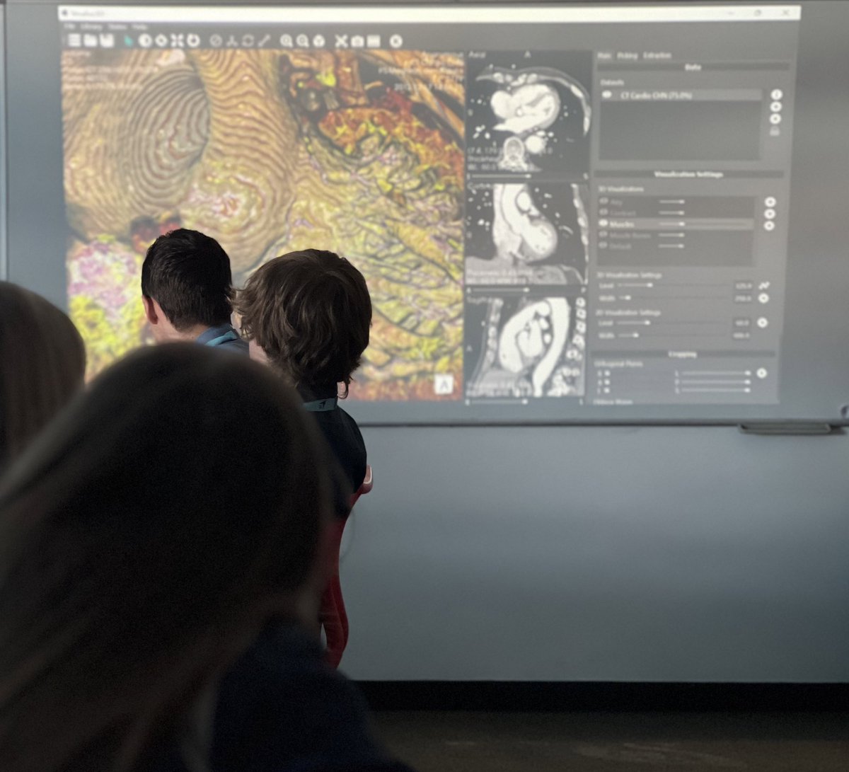 BakerDearing's tweet image. Digital Twins! Professor Jason Laing from @Promake talks about how CT/MRI scans and segmentation allow surgeries to be planned, 3D print custom implants and also run simulations on patients! He also mentioned how he is benefited from this technology! #UTCApex23 #DigitalHealth