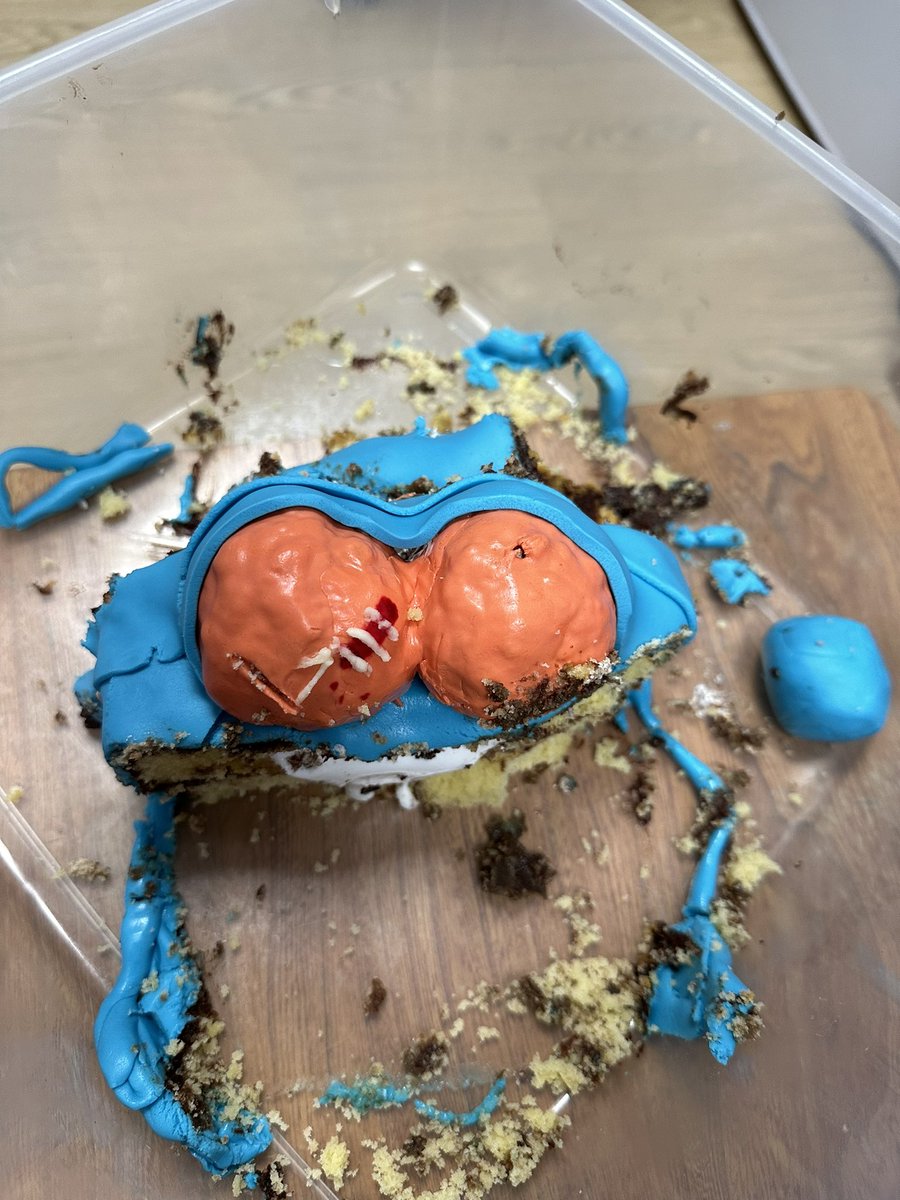 Brilliant day celebrating my 1000th vasectomy with the BEST cake EVER made by my most wonderful HCA Rachel. Feeling loved and happy working with the best team in Sexual Health. ❤️ 😀 🥳🍰🤣