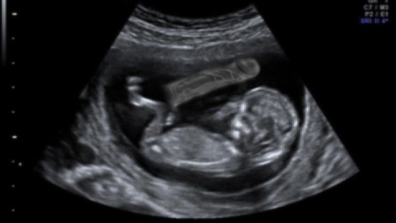 guilletoledano_'s tweet photo. Enhorabuena, es niña! https://t.co/KSRgIl31y2