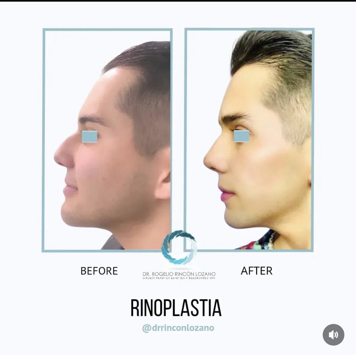 DrRogelioRincn1's tweet photo. Aquí les dejo un #beforeandafter. Siempre afirmó que los cambios que vemos en nuestros pacientes son el resultado del trabajo en equipo y aportaciones de personas que son excelentes en su campo. #nosejob #aguileña #cirugiaplastica #CDMX #plasticsurgery #rinoplasty #morphingtime https://t.co/wnjwRVzfxK
