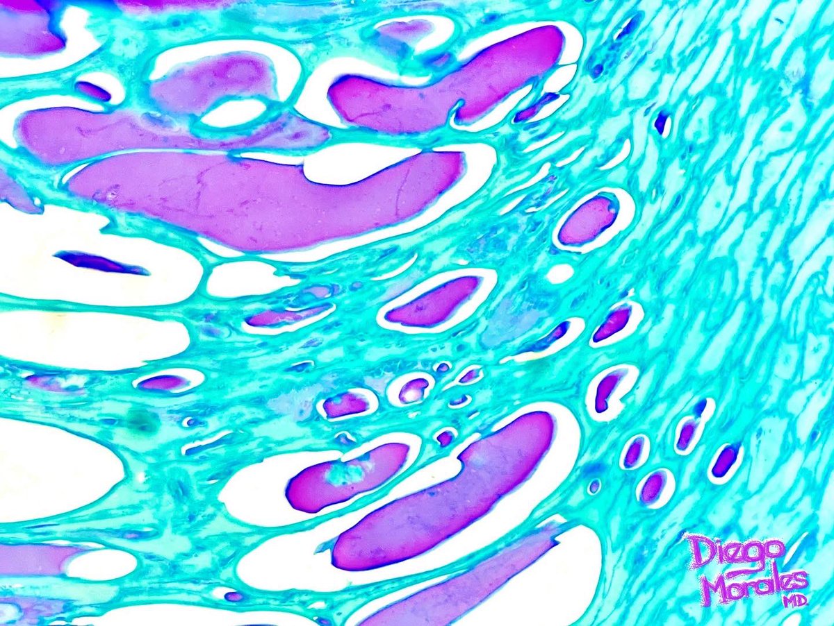 DiegoMoralesN's tweet photo. “If you think something is ugly, look harder. Ugliness is just a failure of seeing.” Matt Haig (The Humans).
#PathArt from clinically ‘ugly’ nails.
#TooPrettyNotToShare #PathTwitter #JoyForMorphology #freudeandermorphologie https://t.co/T54KQKo2k2