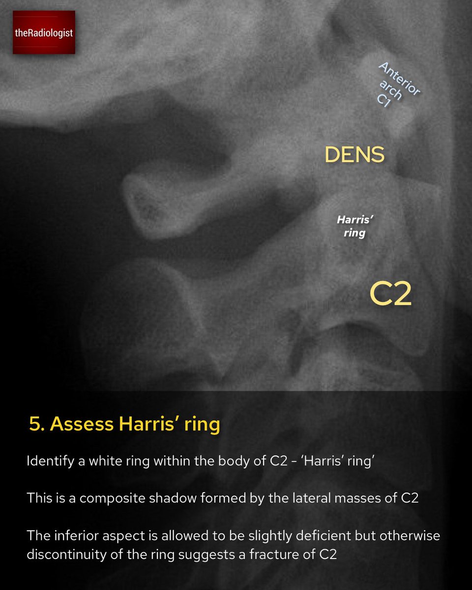 Although CT is first line in many countries X-Ray is still done in many places across the world to a...