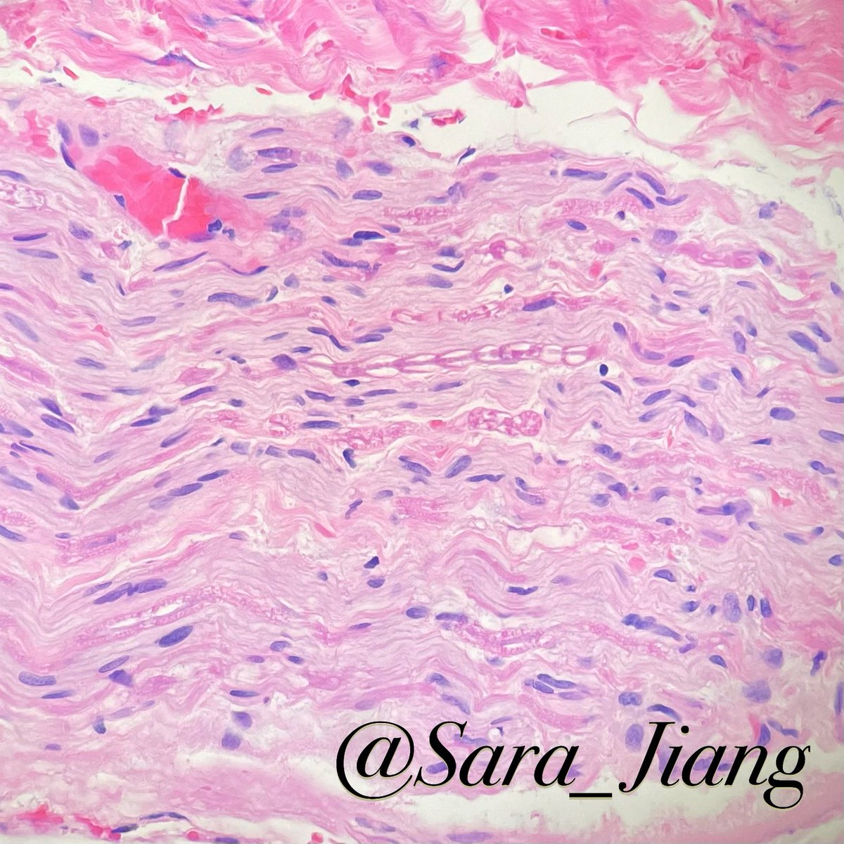 Sara_Jiang's tweet image. Taking a moment to admire the microanatomy of a nerve-the beautiful “fishbone” pattern of Schmidt-Lanterman incisures (breaks in the myelin sheath of axons) is my pathology equivalent of stopping to smell the roses. 

🌹🌹🌹🌹

#SaltatoryConduction #NerdMoment