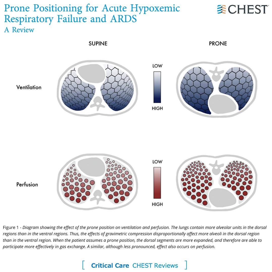 'Belly down, sats up!' Read this CHEST Review to learn more about #pronepositioning. Read the full research in the February issue: hubs.la/Q01BBV500
#JournalCHEST #CHESTCritCare #MedEd