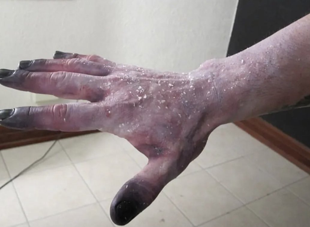 Hastayı saatler sonra enkazdan kurtarmanın sevinciyle son derece iyi niyetle yapacağımız bazı hareketler ekstremite kaybına yol açabilir. 

LOKAL DONMA - SOĞUK ISIRIĞI İÇİN İLK YARDIM +

#depremsondakika #earthquakeinturkey #deprem #Enkaz #Hatay