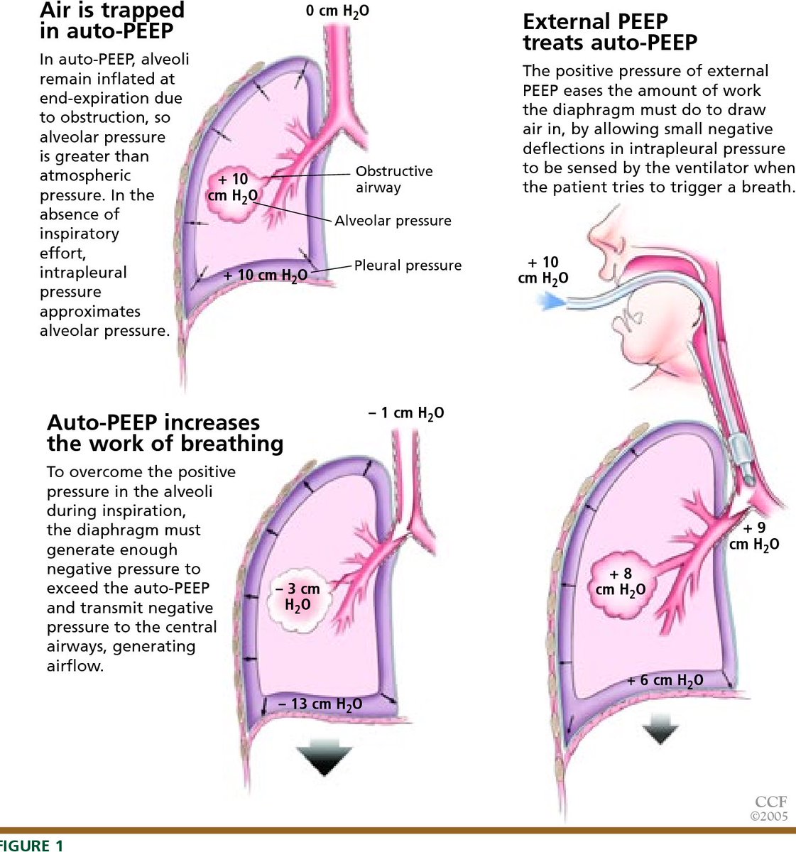 A thread on mechanics, logistics and reasons behind positive end expiratory pressure (PEEP) significance while handling patients on mechanical or non-invasive ventilation 🧵

#MedTwitter #EDTweeter #PulmTwitter @PulmPEEPs