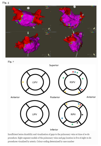 🚨🔥New #FreeRead Article
@JICE_EP

Pulsed Field Ablation in Real-World Afib Patients: Clinical Recurrence, Operator Learning Curve & Redo Procedural Findings

by MH Ruwald, A Johannessen, @LockMorten @haugdalm @ReneWorck & J Hansen

📖🧐#FreeRead rdcu.be/c5gpg

#EPeeps