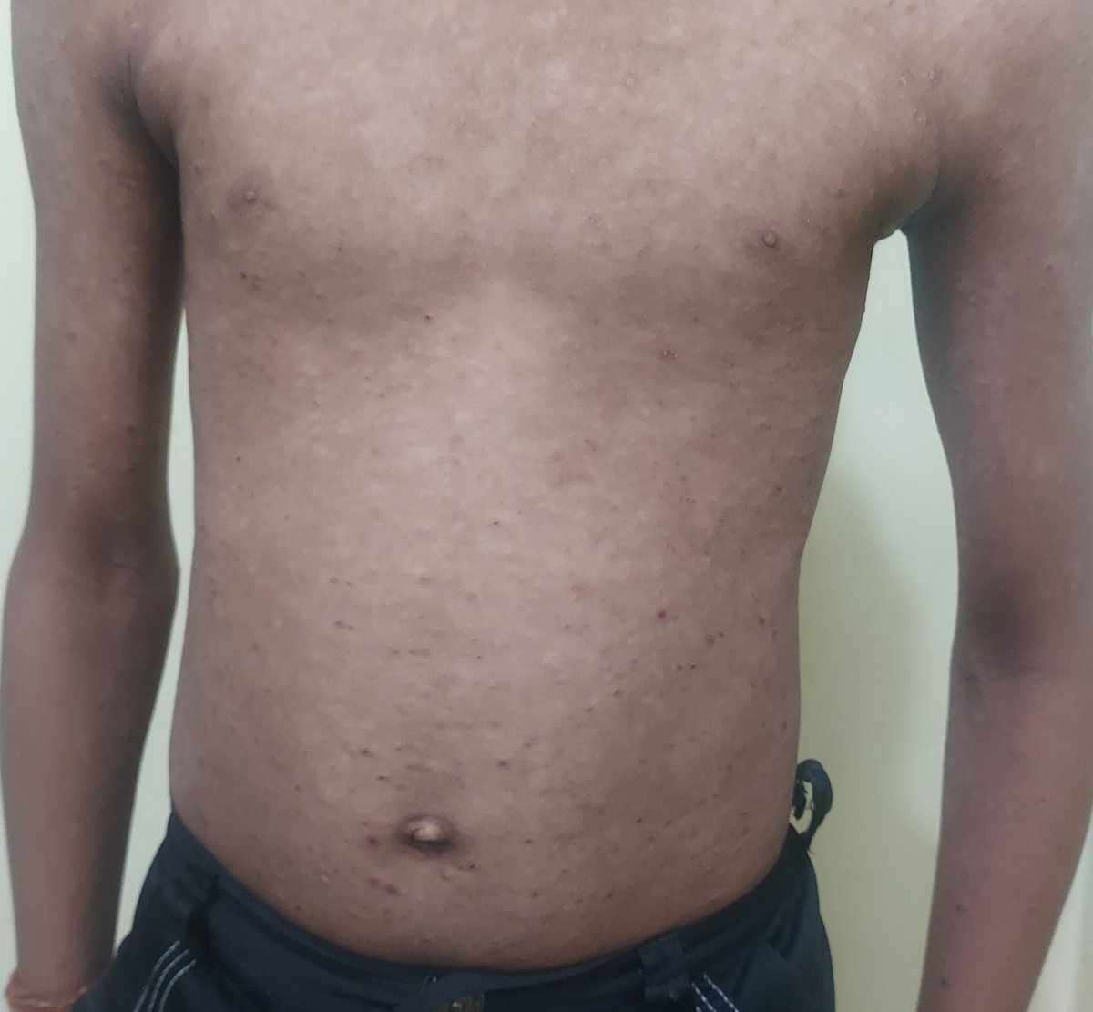 docpiyush's tweet photo. #PedDerm
11M
-Persistent hypopigmentation & Recurrent scaly lesions since 1.5 years
-Mildly itchy
-Trunk & extremities (proximal parts) affected
-Face, mucosa, nails- no significant changes
Dx?
#MedTwitter
#dermtwitter
#dermatology https://t.co/yHPvfobbiw