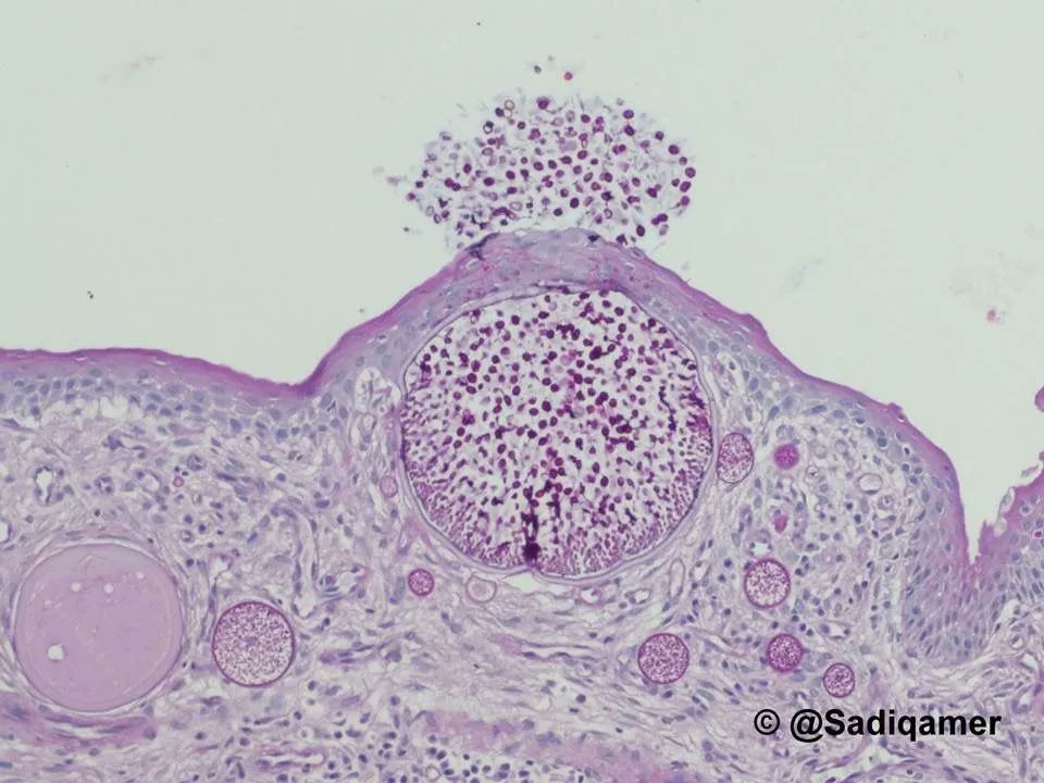 Jerad Gardner, MD (@jmgardnermd) on Twitter photo It's like a tiny infectious volcano! Your diagnosis? Answer & more pics here: kikoxp.com/posts/5703. Many thanks to <a href="/sadiqamer/">Sadiq M Amer, MD</a> MD for these incredible images! #pathology #pathologists #pathTwitter #dermpath #dermatology #dermatologia #dermtwitter #ENTpath #microbiology It's like a tiny infectious volcano! Your diagnosis? Answer & more pics here: kikoxp.com/posts/5703. Many thanks to <a href="/sadiqamer/">Sadiq M Amer, MD</a> MD for these incredible images! #pathology #pathologists #pathTwitter #dermpath #dermatology #dermatologia #dermtwitter #ENTpath #microbiology