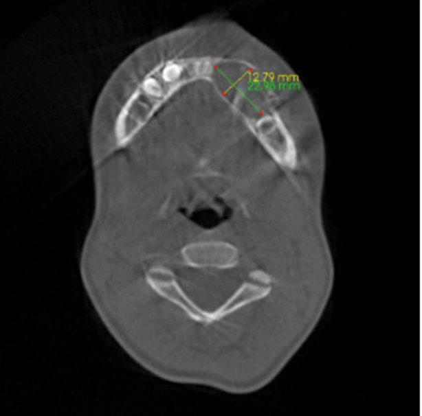 MhPathology's tweet image. Inflamed Dentigerous cyst. 
A 7-year-old boy with an expansive hard cystic lesion at the second premolar of mandible (CBCT). 
Thank you @MetroRadRes for the radiology pic. 
Histology to follow🔬👇

Case by @MalekAsfarMD 

#pathologists #PathTwitter #ENTpath #MedTwitter #pathology