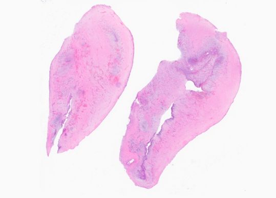 MhPathology's tweet image. Inflamed Dentigerous cyst. 
A 7-year-old boy with an expansive hard cystic lesion at the second premolar of mandible (CBCT). 
Thank you @MetroRadRes for the radiology pic. 
Histology to follow🔬👇

Case by @MalekAsfarMD 

#pathologists #PathTwitter #ENTpath #MedTwitter #pathology