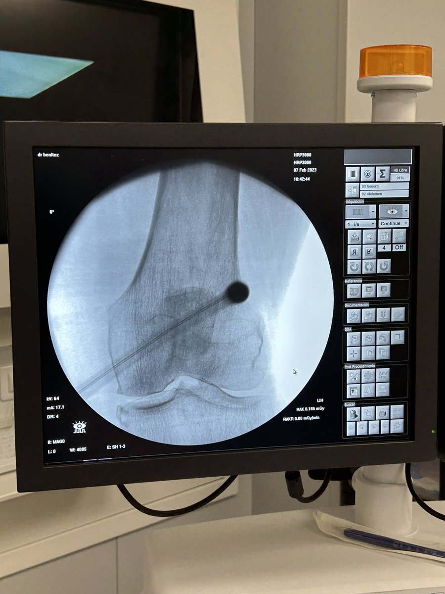 Radiofrecuencia Fría sobre nervios geniculares de rodilla en paciente con OA grado III sin posibilidad quirúrgica por el momento con dolor no controlado con terapias conservadoras ni infiltraciones. @clinicasinalgia @juancasar <a href="/dbpareja/">UTDolor_BENITEZDIEGO</a> <a href="/PedroBenitezP1/">Pedro Benitez P</a> #PainManagement