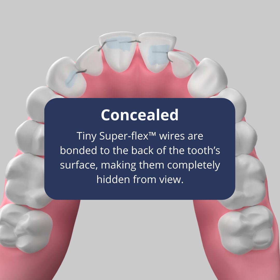 C5HiddenOrtho's tweet image. 🦷 Get to know the 5 C's of C5 Hidden Orthodontics - Custom, Convenient, Concealed, Confidence, and Comfortable. This innovative solution is custom-made to fit your teeth with tiny, behind-the-teeth wires.💥 

#C5hiddenorthodontics #smilewithconfidence #comfortableorthodontics