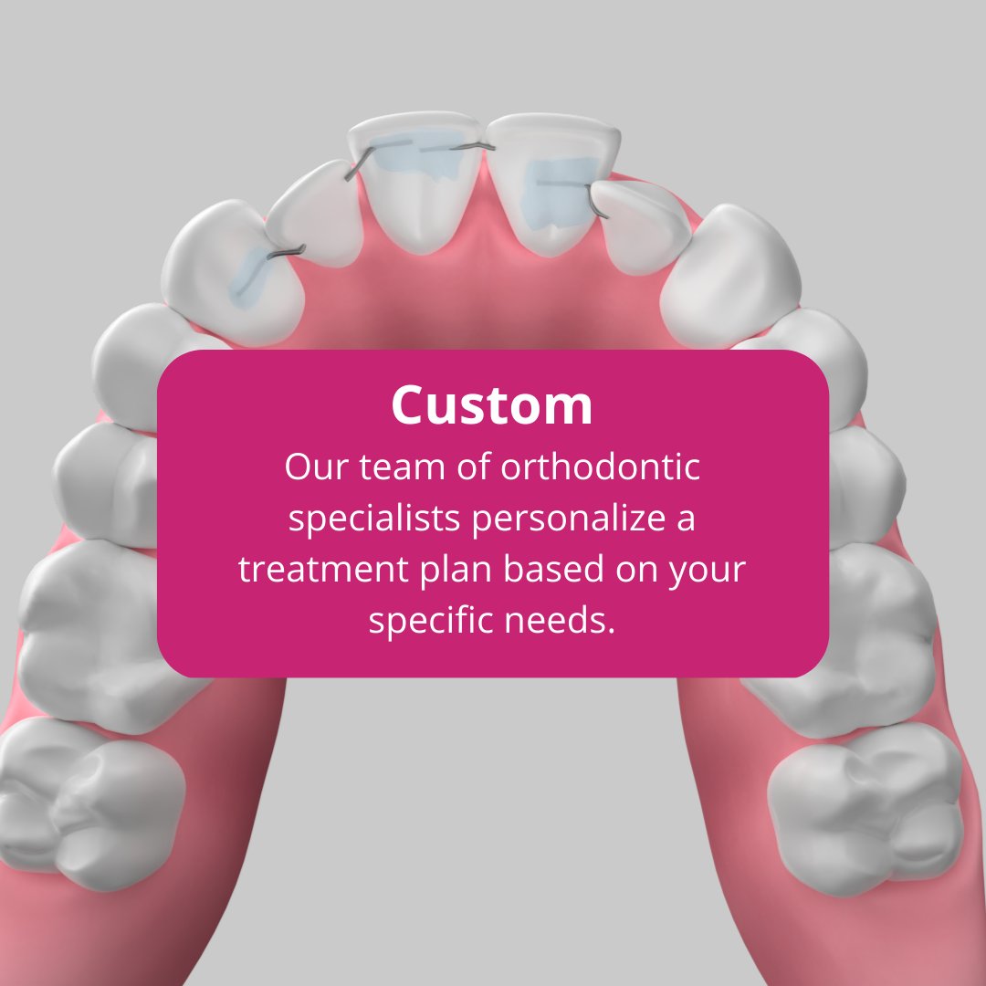 C5HiddenOrtho's tweet image. 🦷 Get to know the 5 C's of C5 Hidden Orthodontics - Custom, Convenient, Concealed, Confidence, and Comfortable. This innovative solution is custom-made to fit your teeth with tiny, behind-the-teeth wires.💥 

#C5hiddenorthodontics #smilewithconfidence #comfortableorthodontics
