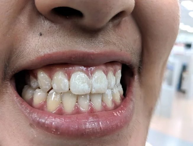 نسبة الفلورايد بالمياة اللي نشربها تلعب دور كبير ومهم لصحتنا وصحة تكوين وسلامة أسناننا 🦷
لأنكم حتى ل...