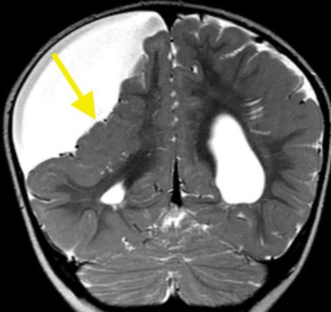 Open lip schizencephaly and additional migrational/organizational anomalies

Schizencephaly can be genetic or acquired due to any insult of the germinal zone prior to migration (insults occurring after migration result in porencephaly)
#neurotwitter @TheASNR #PedsTwitter #radres