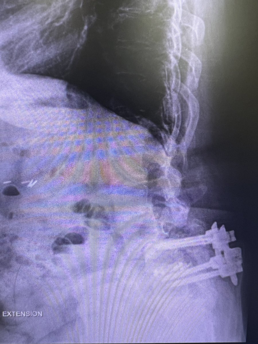 Here is a good example of why we always teach to leave at least 6mm of pars when doing a laminectomy. Especially adjacent to a fusion. ⁦@CNS_Update⁩ ⁦@spinesection⁩ ⁦@AliAlawiehmdphd⁩