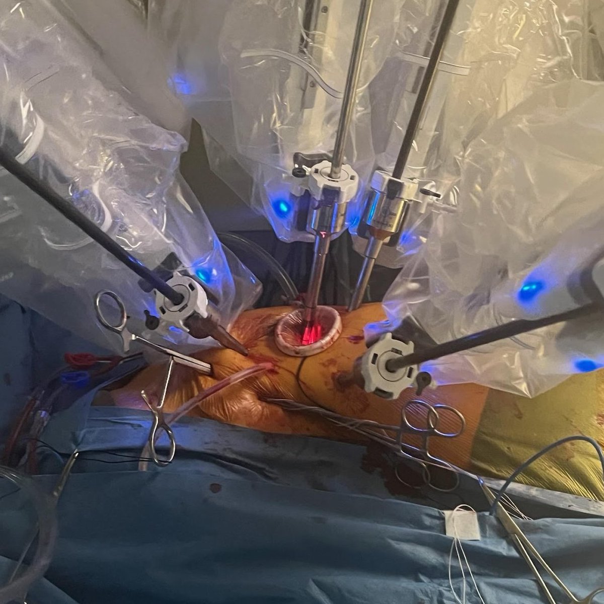 Danny (@dannyramzymd) on Twitter photo Performed the first combined robotic aortic and mitral valve repair @UTheartvascular and @MemorialHermann I am so proud of our team that made this possible. #roboticcardiacsurgery #cardiacsurgery Performed the first combined robotic aortic and mitral valve repair @UTheartvascular and @MemorialHermann I am so proud of our team that made this possible. #roboticcardiacsurgery #cardiacsurgery