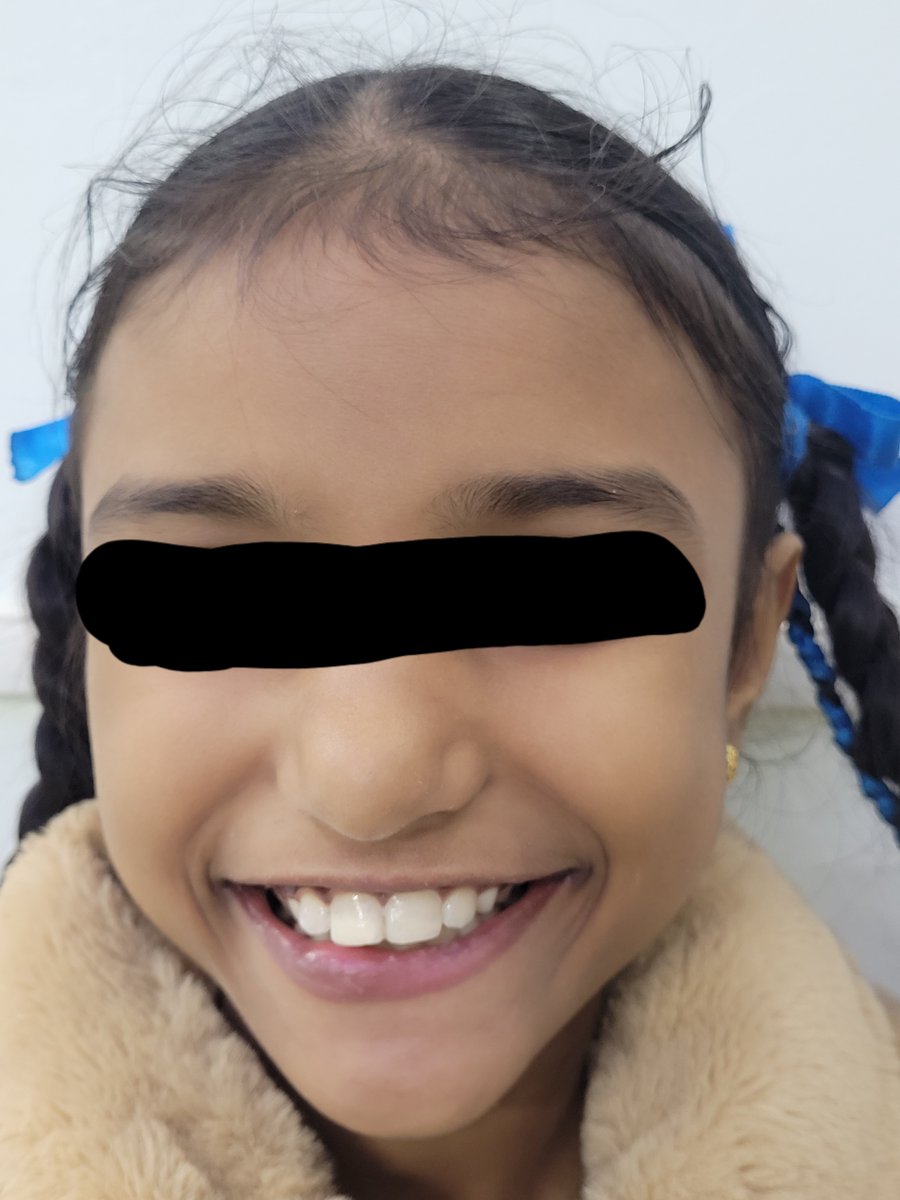AbC967041505's tweet photo. Child, age 9 years, came with Ellis Class 2 # on 21 after fall from stairs
# segment was preserved by parents
Reattached using composite plus partial build up done with #Optra from @ivoclar
Rate and suggest improvements @Pedodentists @IsppdD @Themaxfaxsurge1 https://t.co/lukdkaBsTv