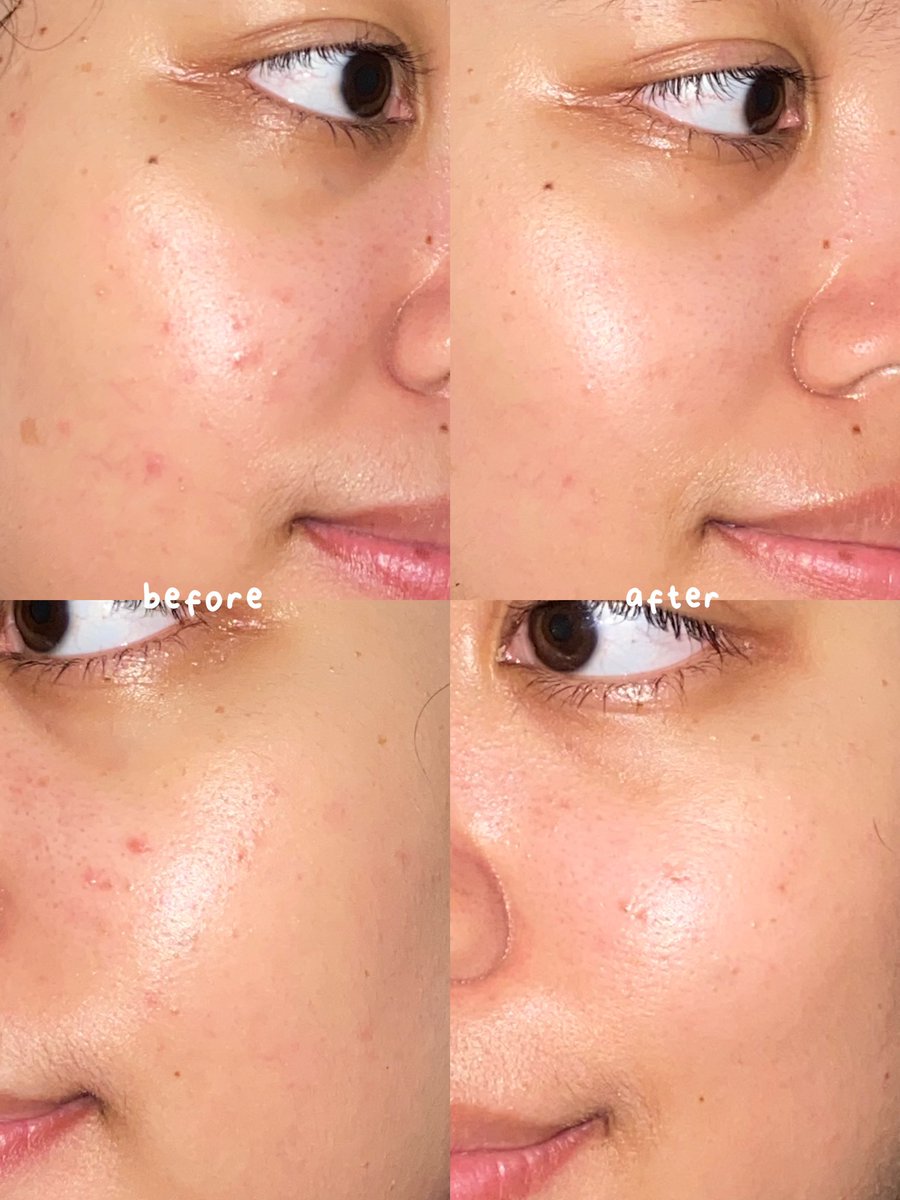 belbeautydiary's tweet photo. Happy banget nemuin combo produk yang bikin kulit jadi kalem, nggak merah merah lagi trus kalo ada jerawat juga jadi nggak meradang
#PakaiSomethinc #StatesTroops #StatesReview #CalmDownMySkin https://t.co/VGpc7rk4WZ