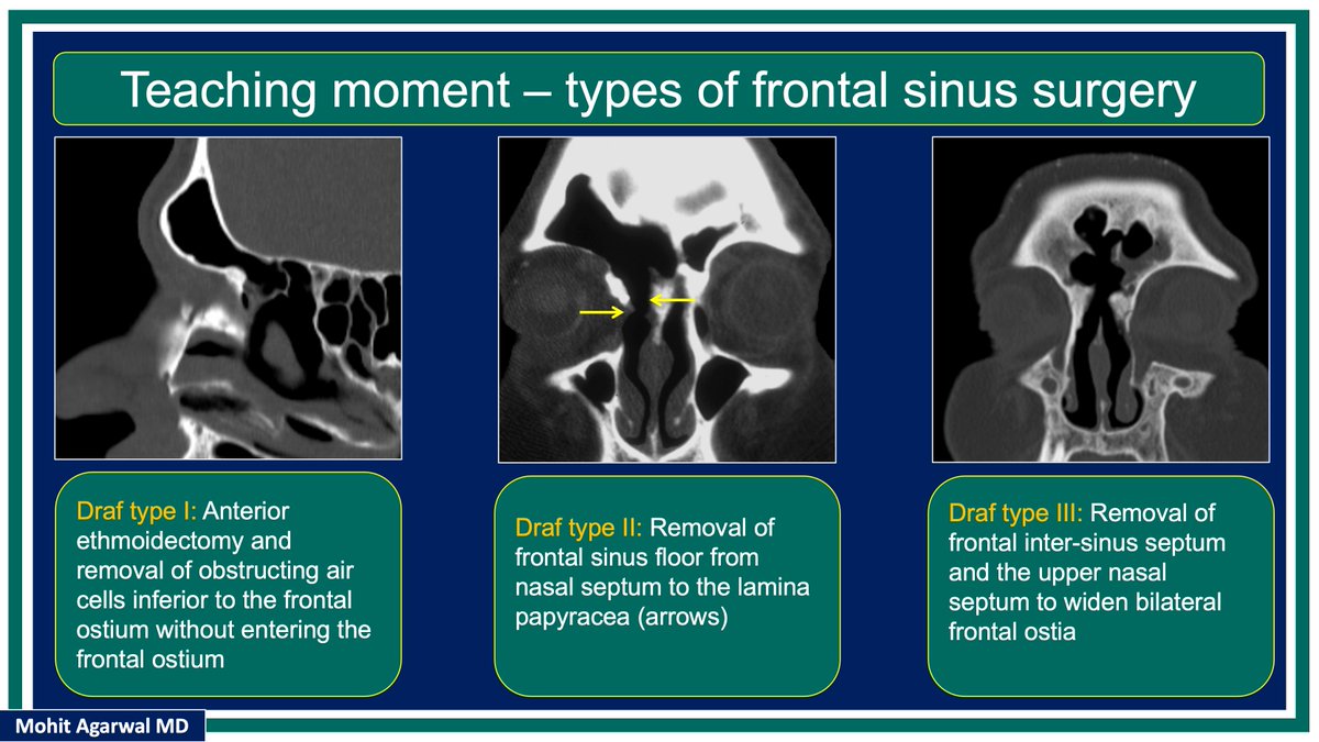 @X (@publishedxprime) on Twitter photo #MCWNeuroradBTW 096 Ans: Osteitis
Check out #TeachingMoment on Chronic sinusitis
#FOAMed #radres #MedEd <a href="/TheASNR/">The American Society of Neuroradiology</a> <a href="/BSHNI_UK/">British Society of Head & Neck Imaging</a> <a href="/ESNRad/">ESNR</a> <a href="/BshniTrainees/">BSHNI Trainees</a> <a href="/ESHNRSociety/">ESHNR</a> <a href="/bdoop3210/">Brian Dupree</a> <a href="/MCWNeurorad/">MCW Neuroradiology</a> <a href="/AwanRad/">Omer Awan MD MPH</a> <a href="/aaronrutman/">Aaron Rutman, MD</a> <a href="/ShivaprakashBH4/">Shivaprakash B. Hiremath</a> <a href="/drSurjthVattoth/">Surjith Vattoth</a> <a href="/RamVaidhyanath/">Ram Vaidhyanath</a> <a href="/AustinWheelerMD/">Austin Wheeler</a> #MCWNeuroradBTW 096 Ans: Osteitis
Check out #TeachingMoment on Chronic sinusitis
#FOAMed #radres #MedEd <a href="/TheASNR/">The American Society of Neuroradiology</a> <a href="/BSHNI_UK/">British Society of Head & Neck Imaging</a> <a href="/ESNRad/">ESNR</a> <a href="/BshniTrainees/">BSHNI Trainees</a> <a href="/ESHNRSociety/">ESHNR</a> <a href="/bdoop3210/">Brian Dupree</a> <a href="/MCWNeurorad/">MCW Neuroradiology</a> <a href="/AwanRad/">Omer Awan MD MPH</a> <a href="/aaronrutman/">Aaron Rutman, MD</a> <a href="/ShivaprakashBH4/">Shivaprakash B. Hiremath</a> <a href="/drSurjthVattoth/">Surjith Vattoth</a> <a href="/RamVaidhyanath/">Ram Vaidhyanath</a> <a href="/AustinWheelerMD/">Austin Wheeler</a>