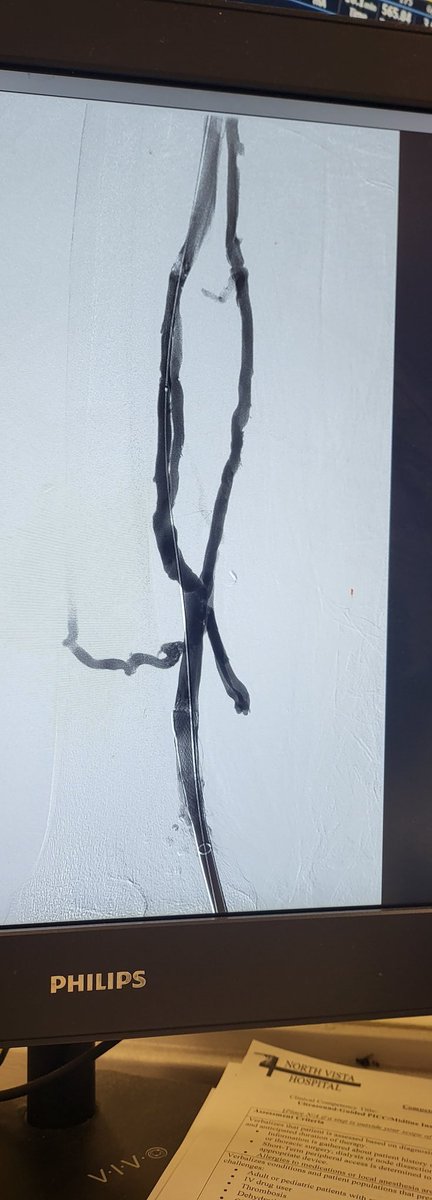 AdrianMercadoMD's tweet photo. 34yo guy , underwent recent thrombectomy with different device, rethrombosed.. (iliac compression left unstented) Got #inari #clotTrieverBold passes om both branches ivus'ed balloon-stent -done ->lovenox 👌#inari https://t.co/hh1cXFDwJG