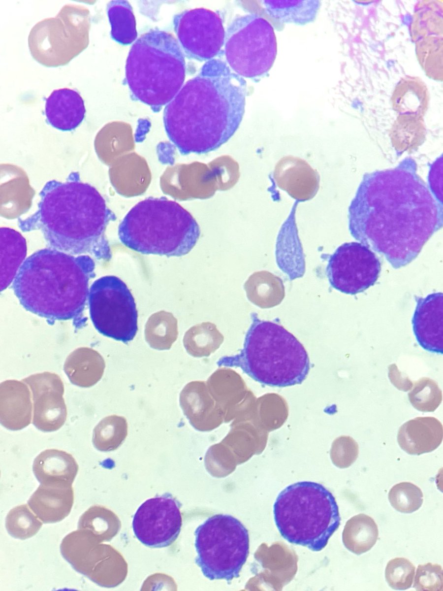 RLoyaux's tweet photo. Pic of the week ! #aml #hematology #blebs https://t.co/kVvnIG45cm
