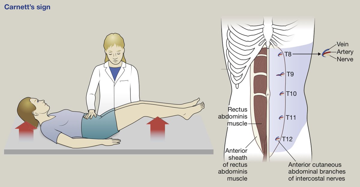 drkeithsiau's tweet photo. Carnett’s sign refers to focal abdominal pain along the rectus sheath which is worse with head or leg raising. This is a sign of anterior cutaneous nerve entrapment syndrome (ACNES) which can be treated with local anaesthetic injections #MedEd 

https://t.co/c4t1UiCVnf https://t.co/SQYd3bYdZ4