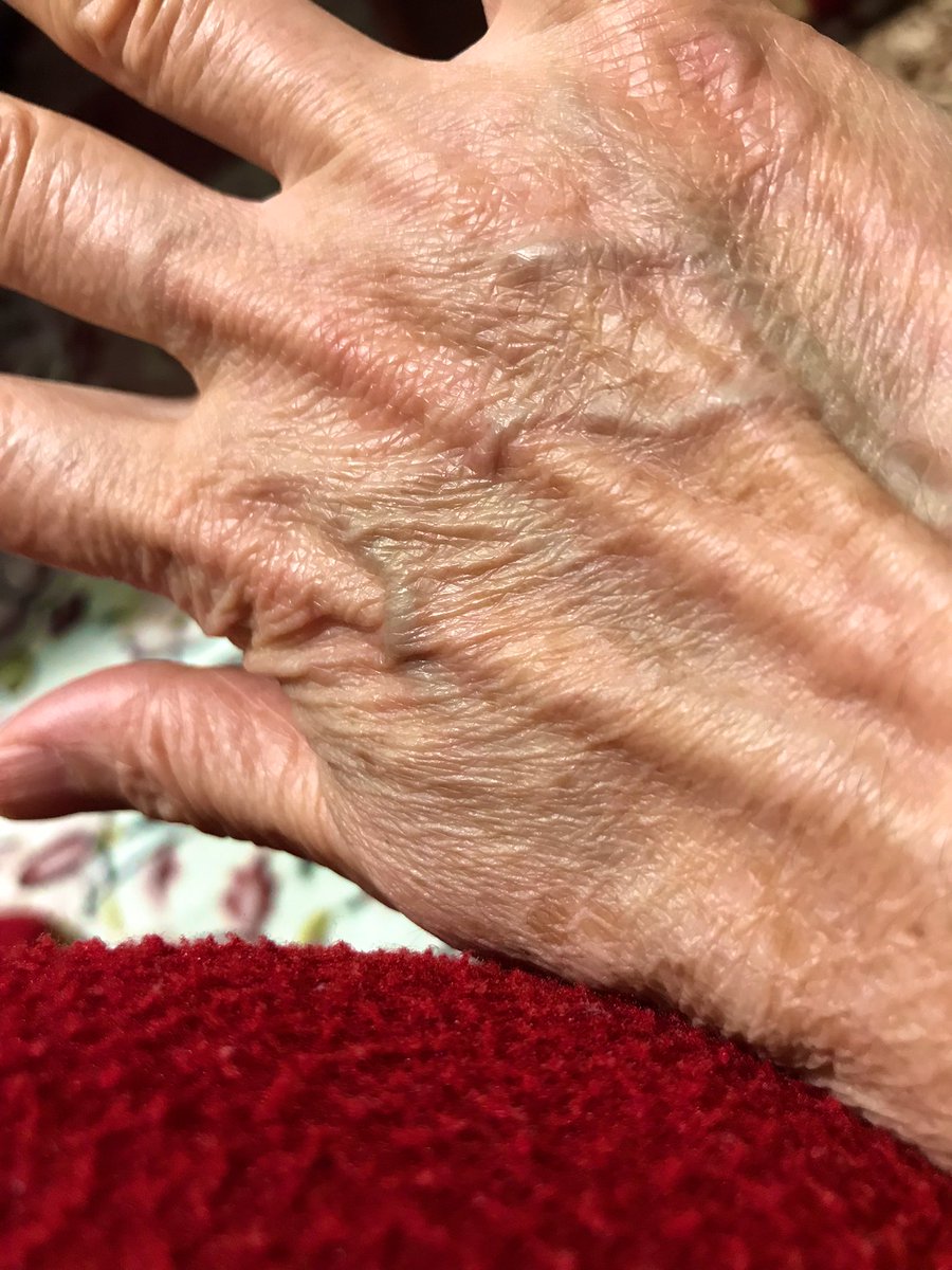 AppleCandyJP1's tweet image. これが私の手。61歳のは見えない。それだけ(いっきに)心臓や肺がダメージを食らったみたい。以前ツイートしたように、主治医から86歳おじいちゃんのようだと言われたことがあって、顔も手もシワシワでハリもツヤも筋力もない。生かすなら大事にしてほしいです。
#心不全　#POCD(肺気腫)