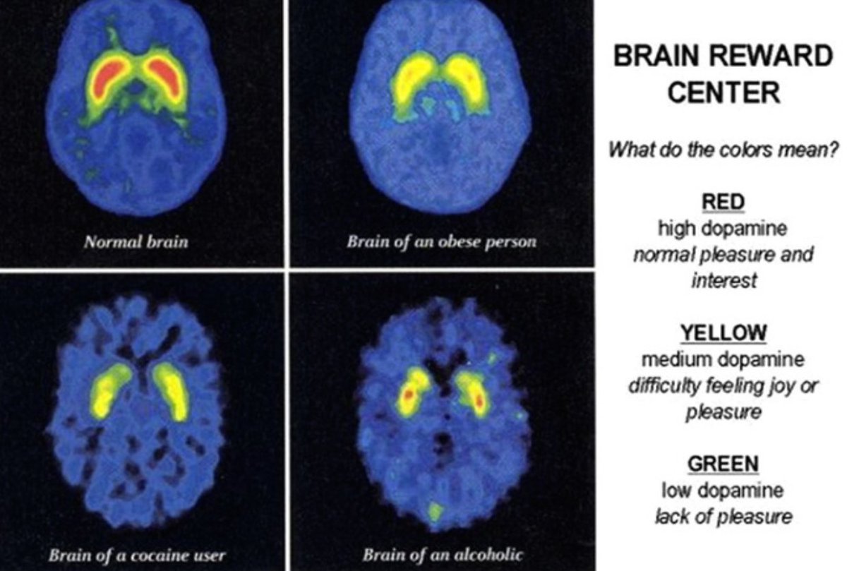 Brain scans show: Sugar lights up the brain's reward centers even ...