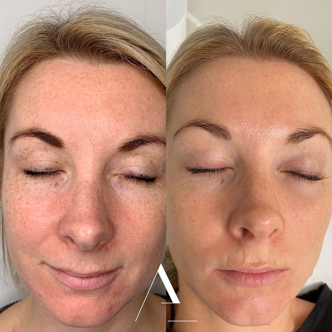 noaemskin's tweet photo. Skin Transformation! 🤍 
This lady is a busy working mum.

Her commitment to her bespoke treatment plan was strong and the results speak for themselves. 

Her pigmentation, breakouts, skin texture, skin laxity and fine lines are so much improved. 

Book online now! https://t.co/S7gT7ct0dY