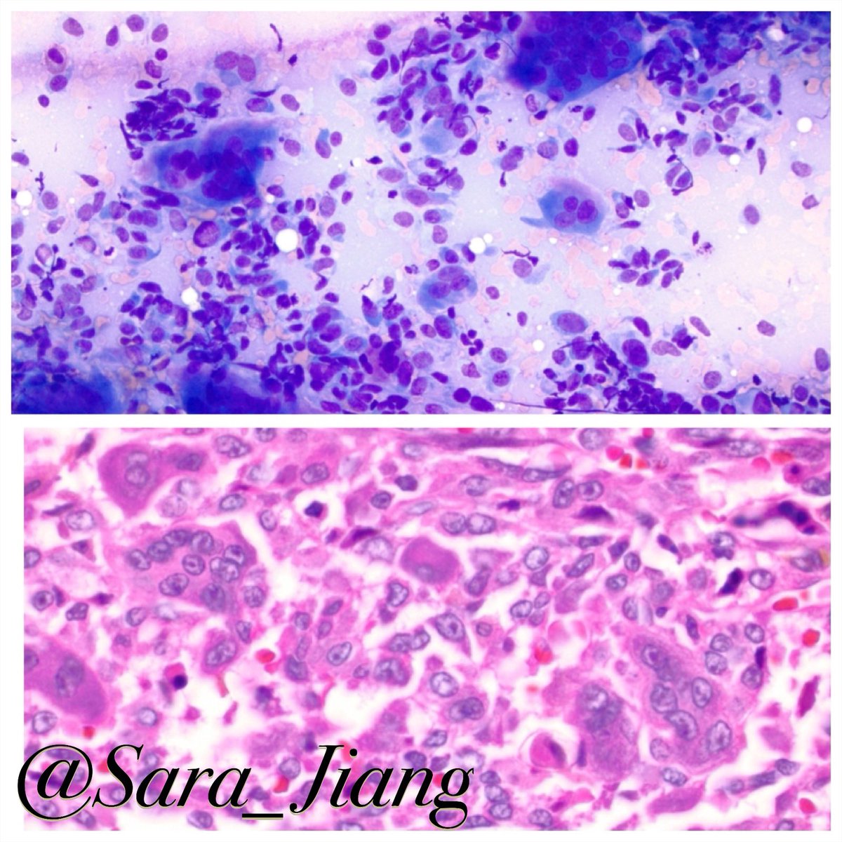 Sara_Jiang's tweet photo. Today’s #FNAFriday #CytoHisto correlation
Giant cells in a background of bland mononuclear cells in a case of giant cell tumor
(Top:DQ Below:H&E)
👉🏼#PathPitfall: giant cell differential is broad! https://t.co/ImdpiL1vMm