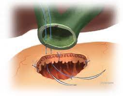 Gio_Marchegiani's tweet photo. Interrupted 🤜🤛 continuous suture technique for biliary-enteric anastomosis 🪡 a RCT

⌛️ Interrupted longer time (22 vs. 12 min)
🌱 Anastomosis equally safe

👩‍🎓 What is your practice!? Choosing depending on size !? How do you train residents?! 

https://t.co/2pZVDyi1Jr https://t.co/Cj97L7ucNq