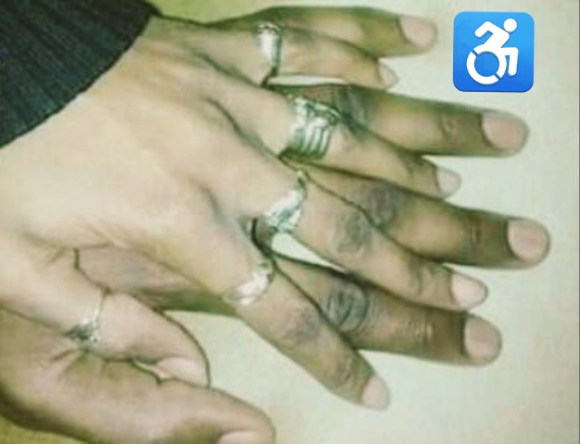 GwiziSoneni's tweet photo. #DisabilityAwareness
#RelationshipsAndDisability
#DidYouKnow
The word #Interabled means a person without a #Disability & a #PWD being together❤️in a love relationship It can indicate that people have two different disabilities
#DisabilityCulture
Ps I have beautiful😍fingers😃😀 https://t.co/cPHMgCeaQs